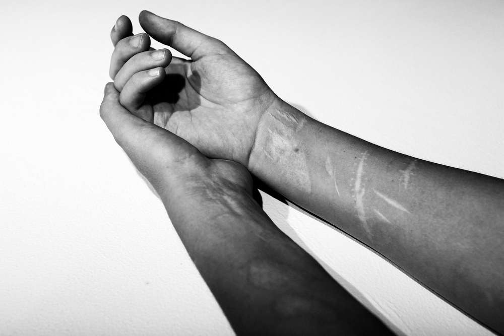 suicidal-behaviour-hand-injuries