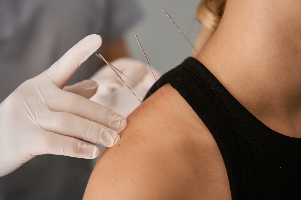 young-woman-Acupuncture-therapy-on-shoulder