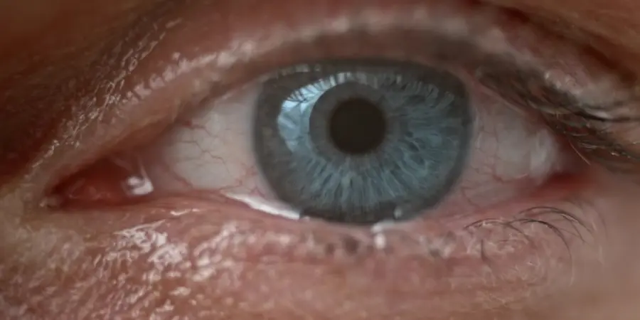 Watery eye as a withdrawal symptom from opiate detox