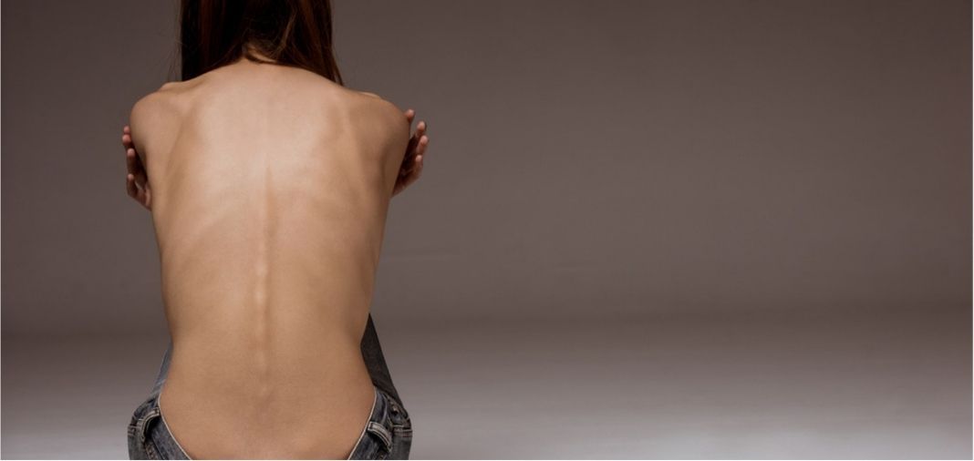 anorexia woman suffring weightloss