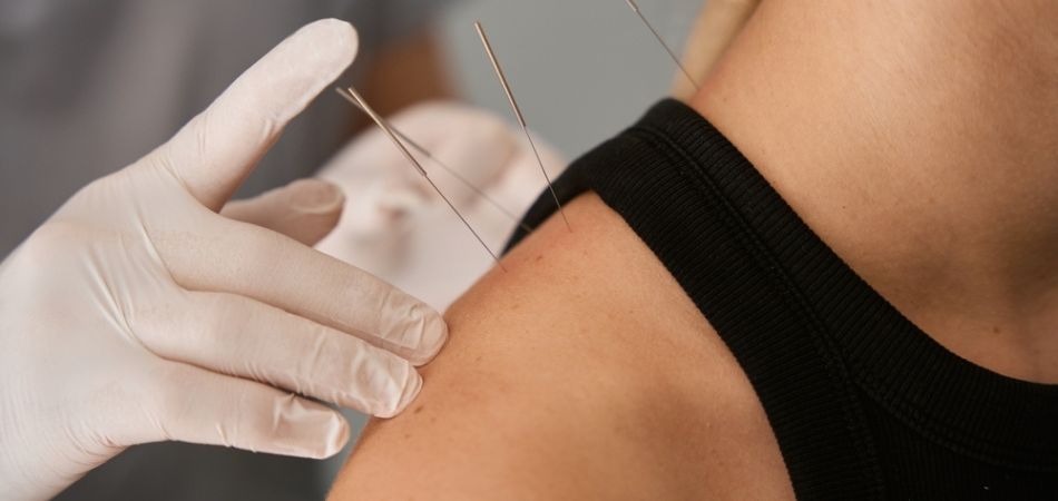 young woman Acupuncture therapy on shoulder