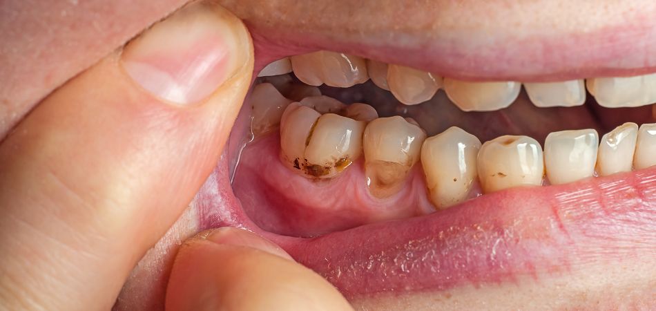 tooth stained for addiction